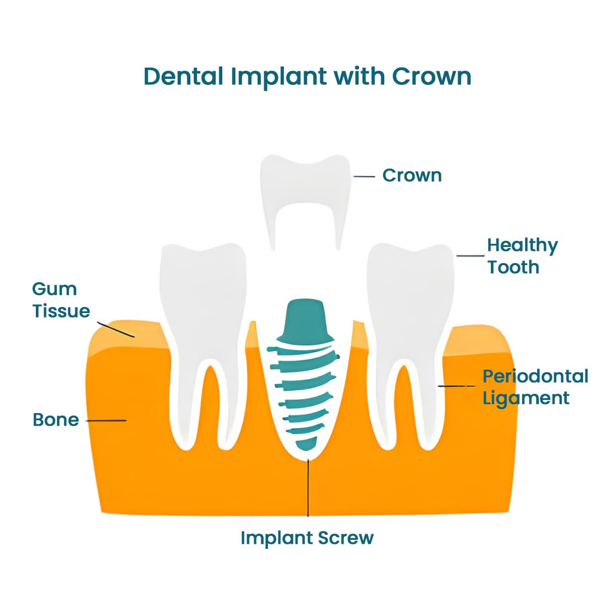 Dental implant diagram showing implant screw, crown, gum tissue, bone and periodontal ligament.