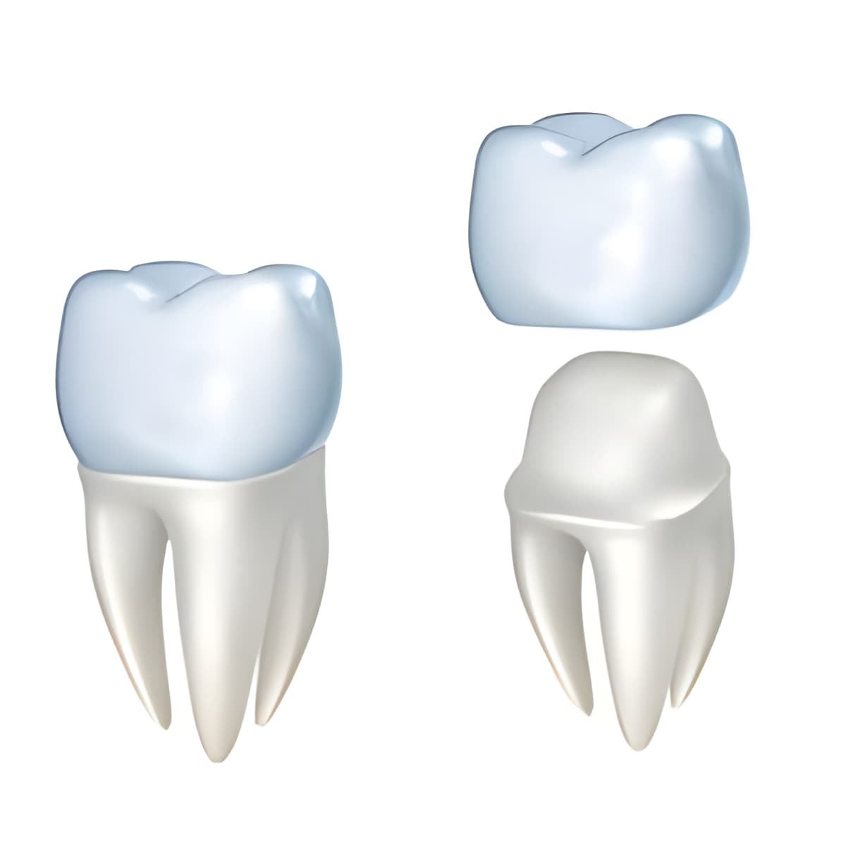 Dental crown illustration showing tooth preparation and crown placement