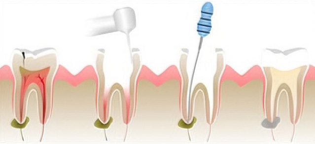 Illustration showing stages of root canal treatment on infected tooth