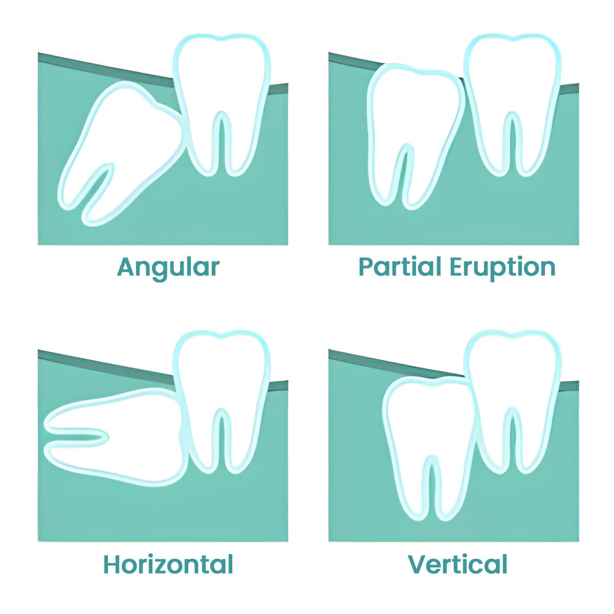 Wisdom tooth impaction types illustration for dental treatment. Book your consultation.