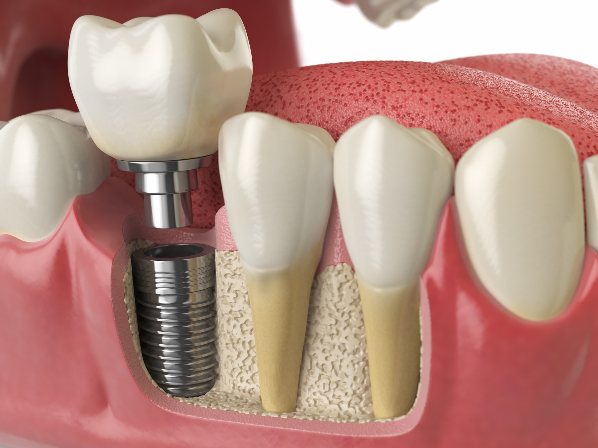 3D illustration showing a dental implant, abutment and crown replacing a missing tooth.